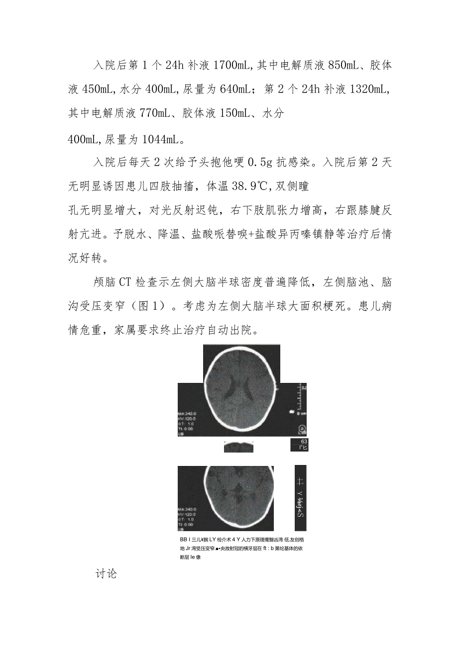 神经内科小儿重度烧伤并发大面积脑梗死病例分析专题报告.docx_第2页