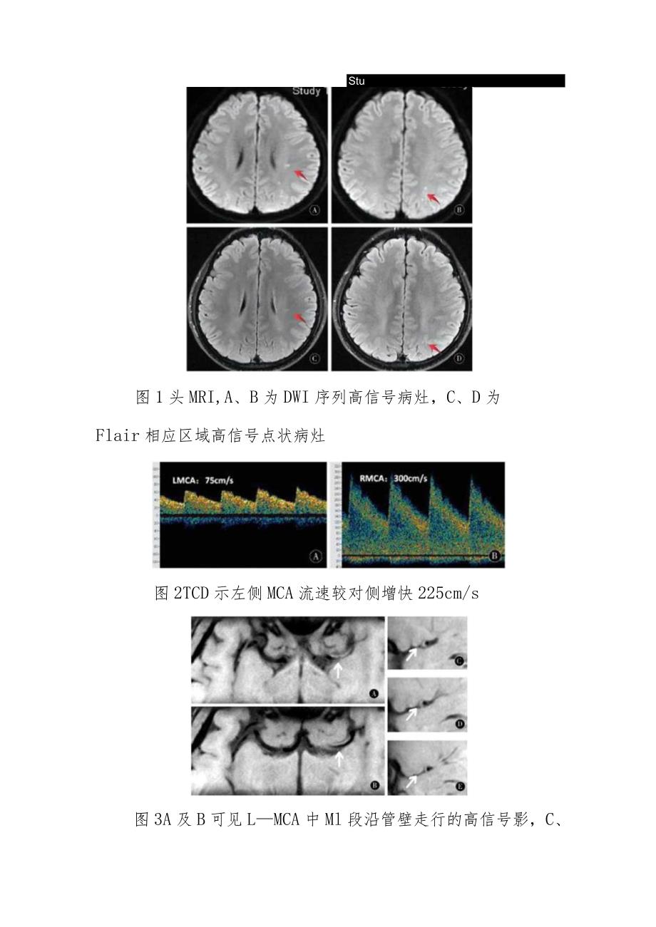 神经内科大脑中动脉粥样硬化形成的青年脑梗死病例报告专题报告.docx_第3页