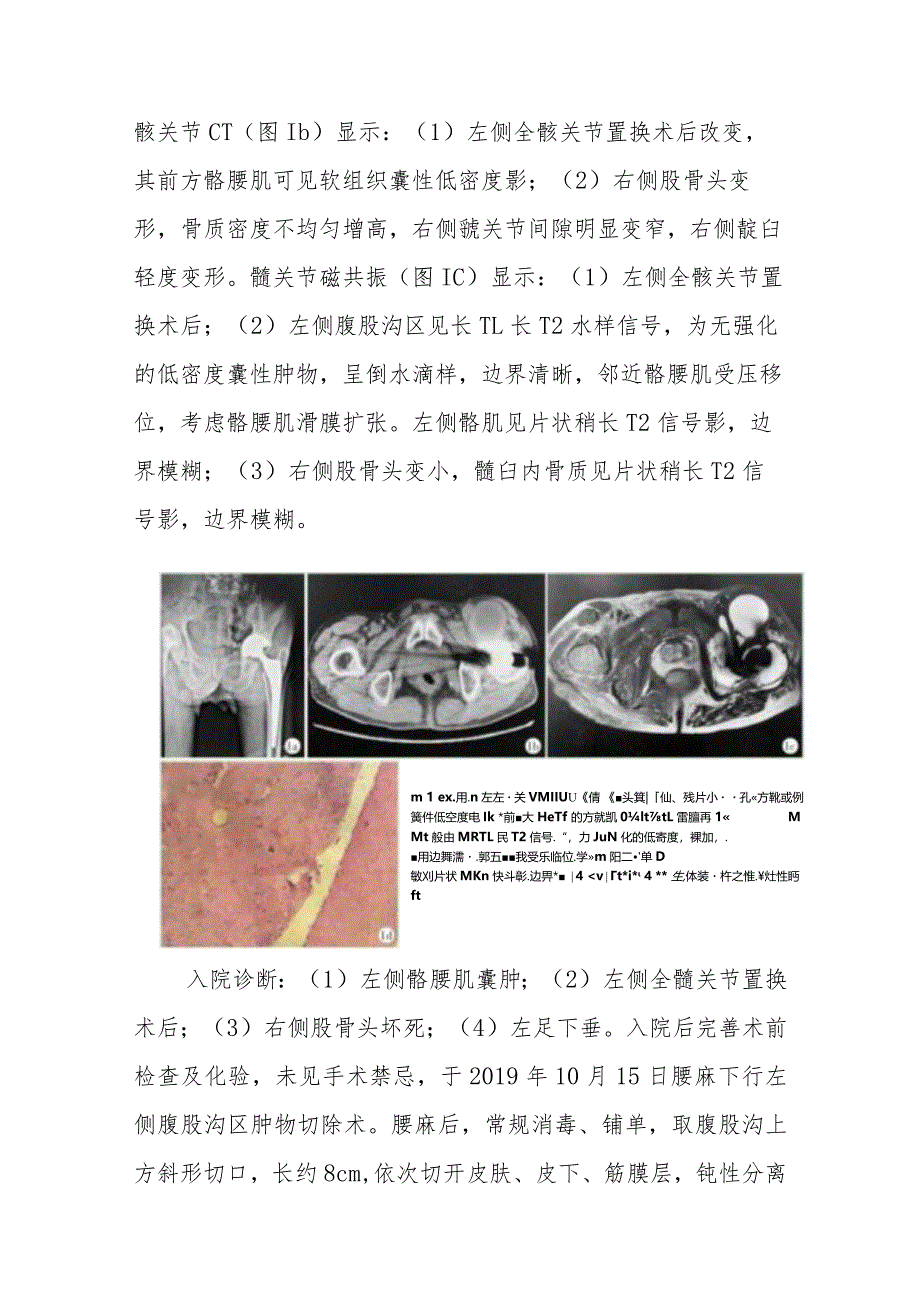 外科髂腰肌巨大囊肿病例分析专题报告.docx_第2页