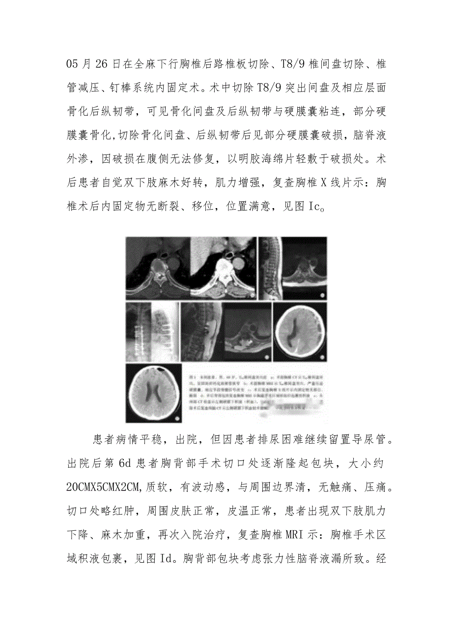 脊柱外科胸椎间盘突出症术后多种并发症病例分析专题报告.docx_第2页