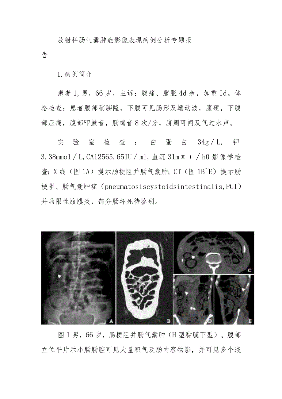 放射科肠气囊肿症影像表现病例分析专题报告.docx_第1页