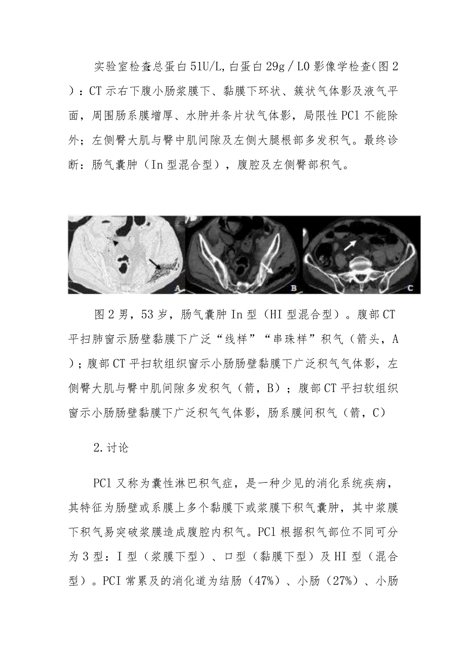 放射科肠气囊肿症影像表现病例分析专题报告.docx_第3页