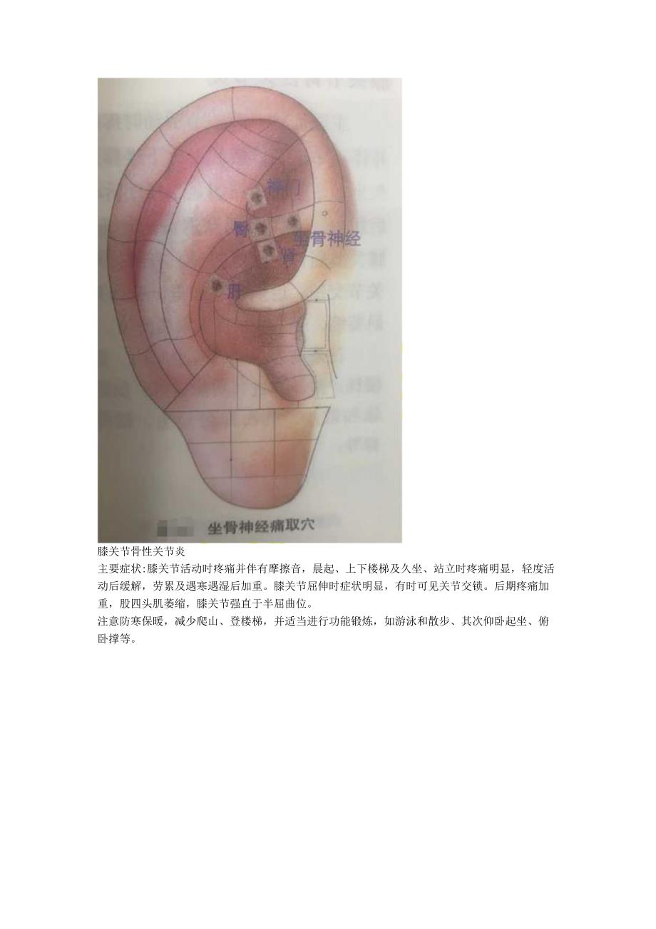 9.21耳穴 手腕扭伤 坐骨神经痛 膝关节炎.docx_第2页