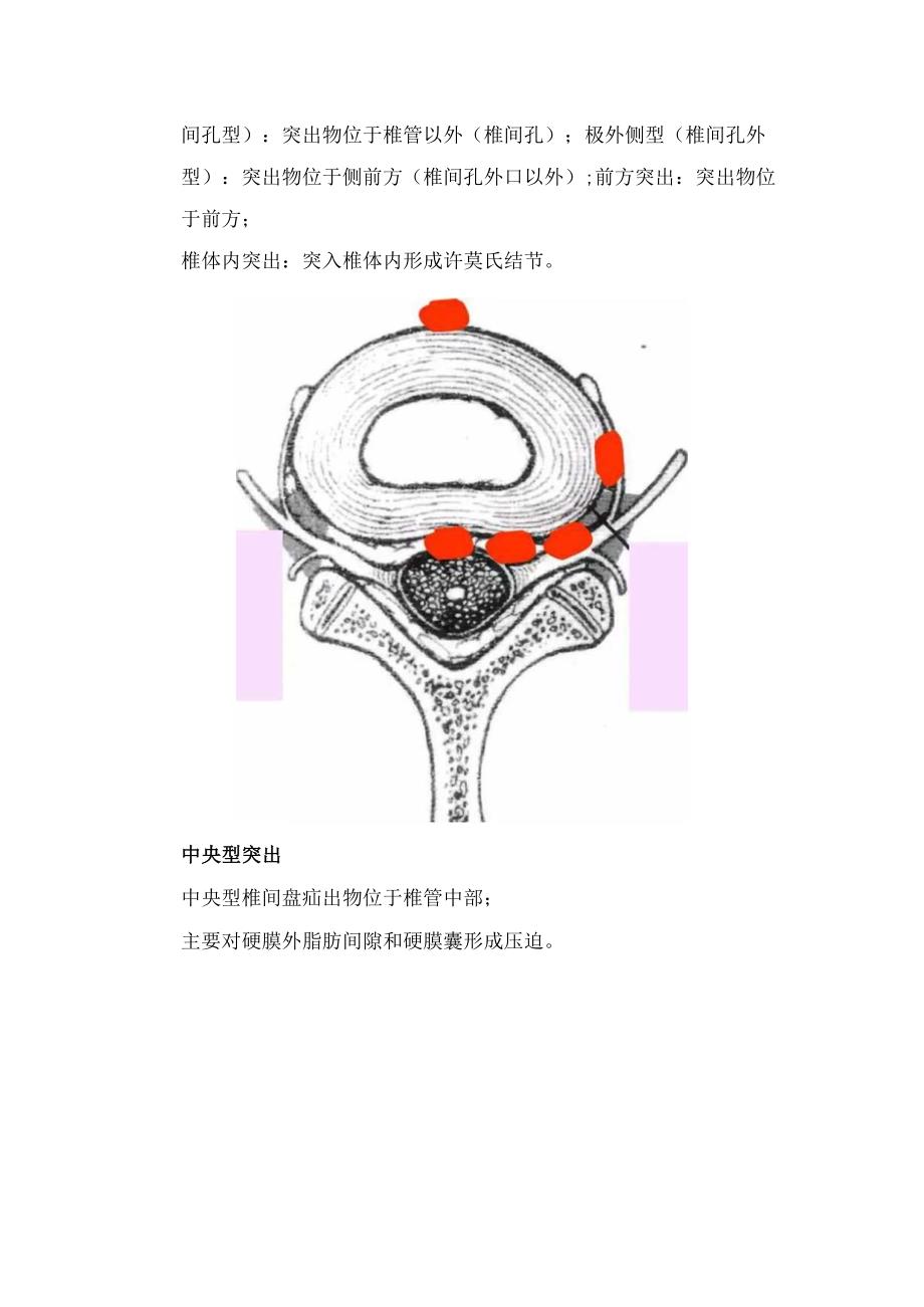 中央型、旁中央型、外侧型（椎间孔型）、极外侧型、前方突出、椎体内突出等椎间盘突出的影像征象和临床表现.docx_第2页