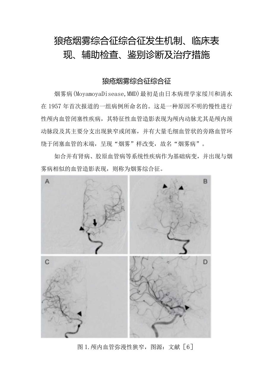 狼疮烟雾综合征综合征发生机制、临床表现、辅助检查、鉴别诊断及治疗措施.docx_第1页