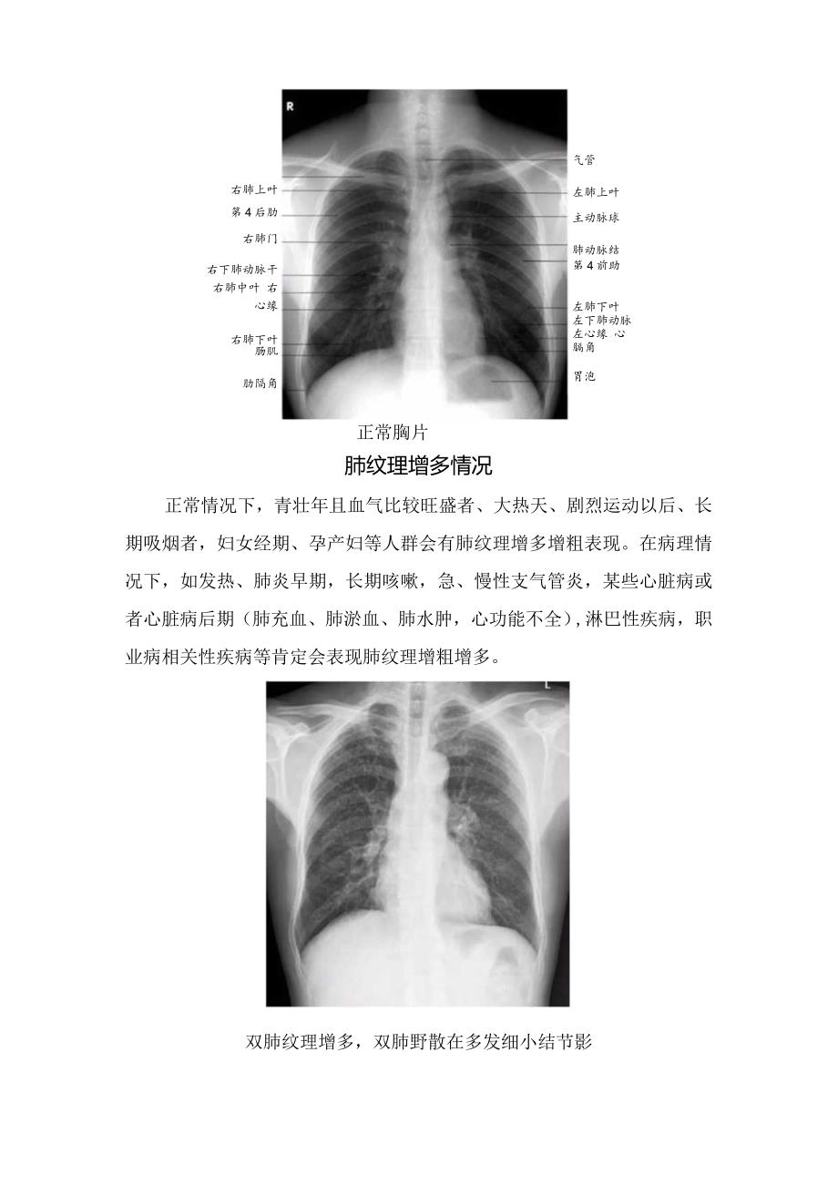 肺纹理构成、胸片表现、肺纹理增多情况及增多理解.docx_第2页