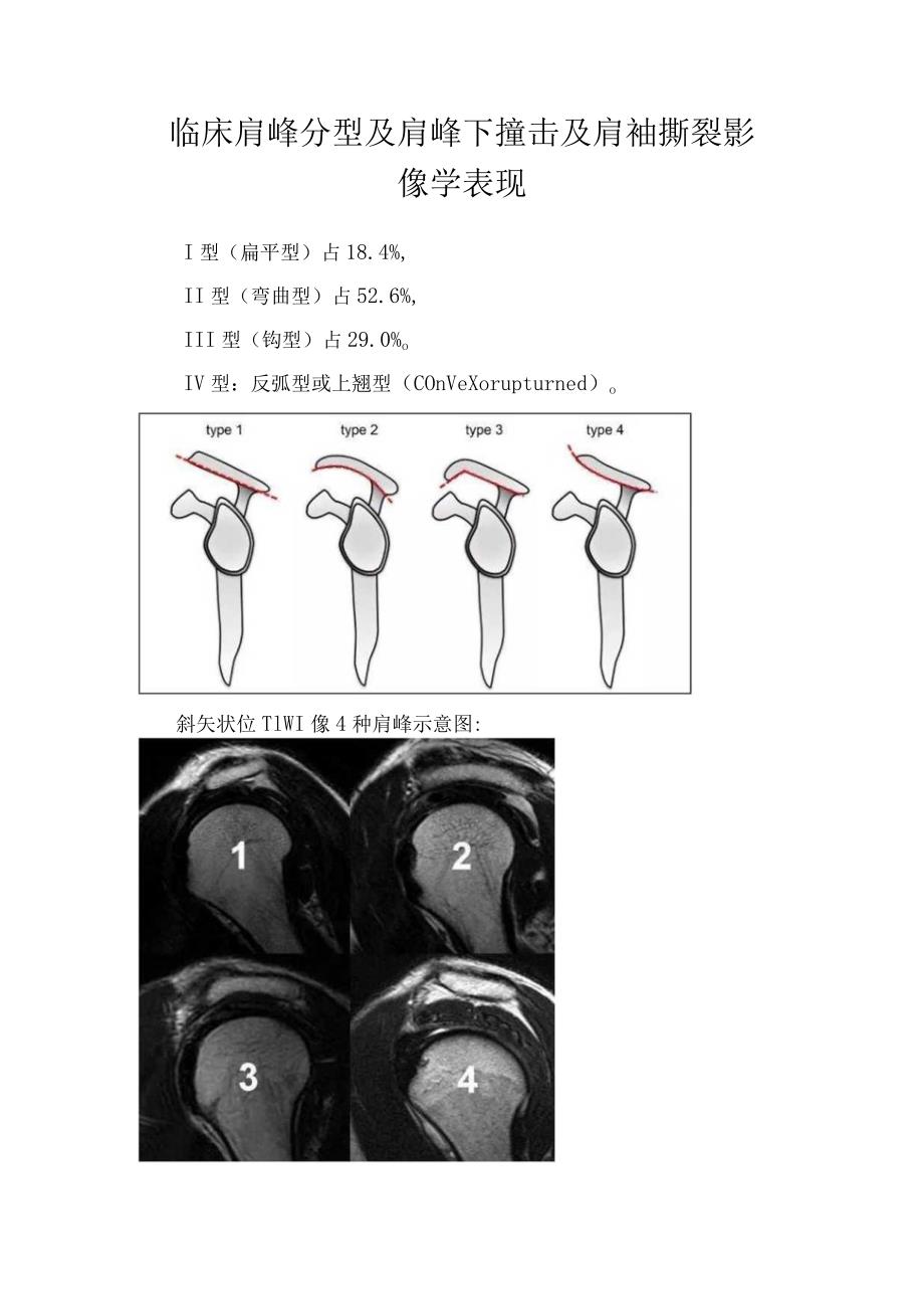 临床肩峰分型及肩峰下撞击及肩袖撕裂影像学表现.docx_第1页