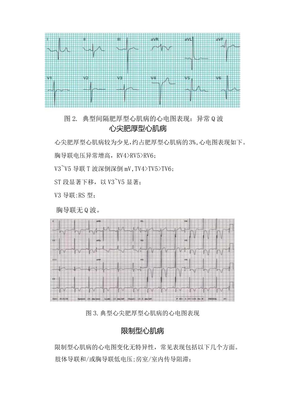 临床扩张型、肥厚性、间隔肥厚性、心尖肥厚型、限制型、致心律失常性右室、继发性、酒精性、 围产期等心肌病心电图特征.docx_第3页