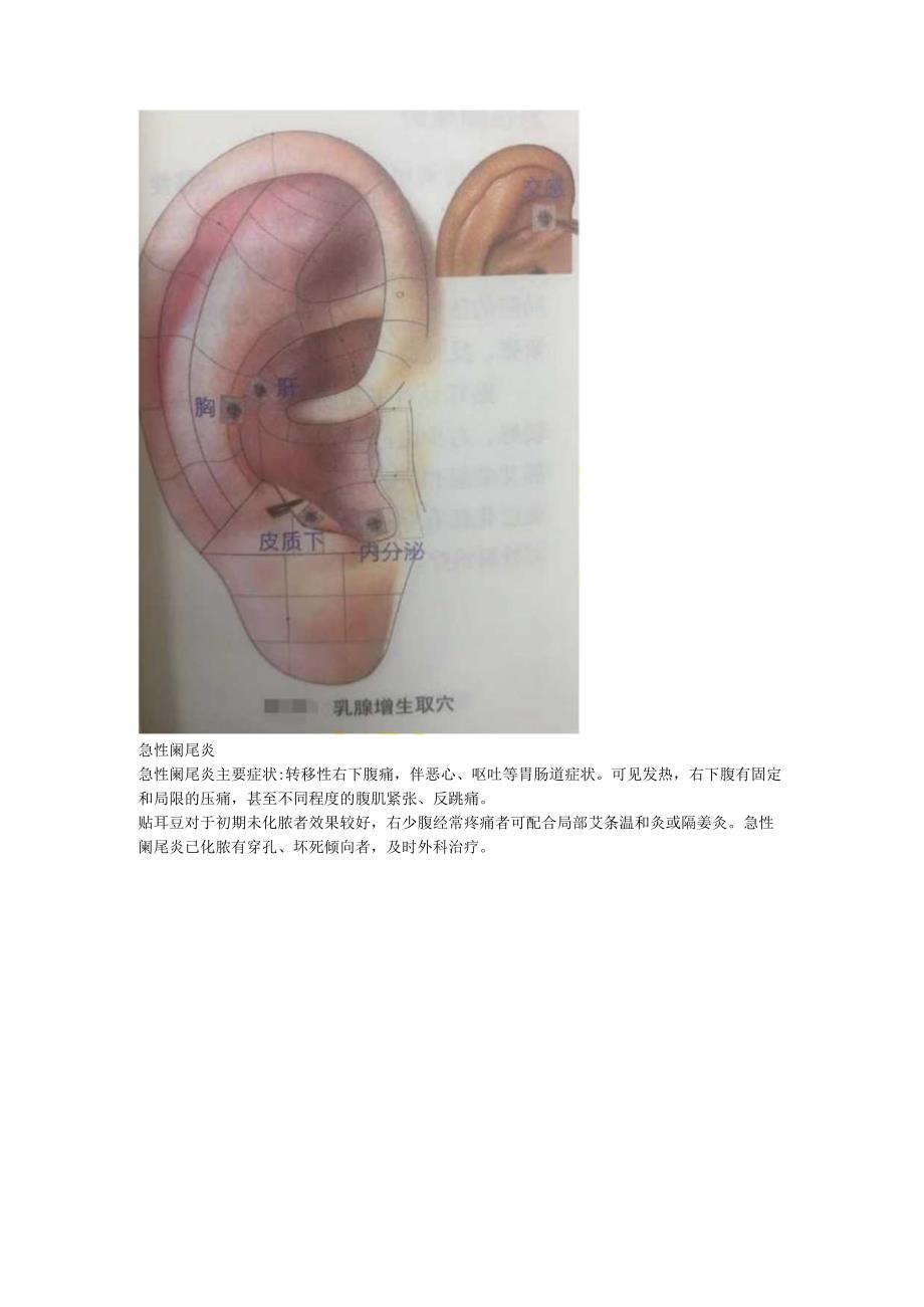 2.19耳穴 乳腺增生 阑尾炎 痔疮.docx_第2页