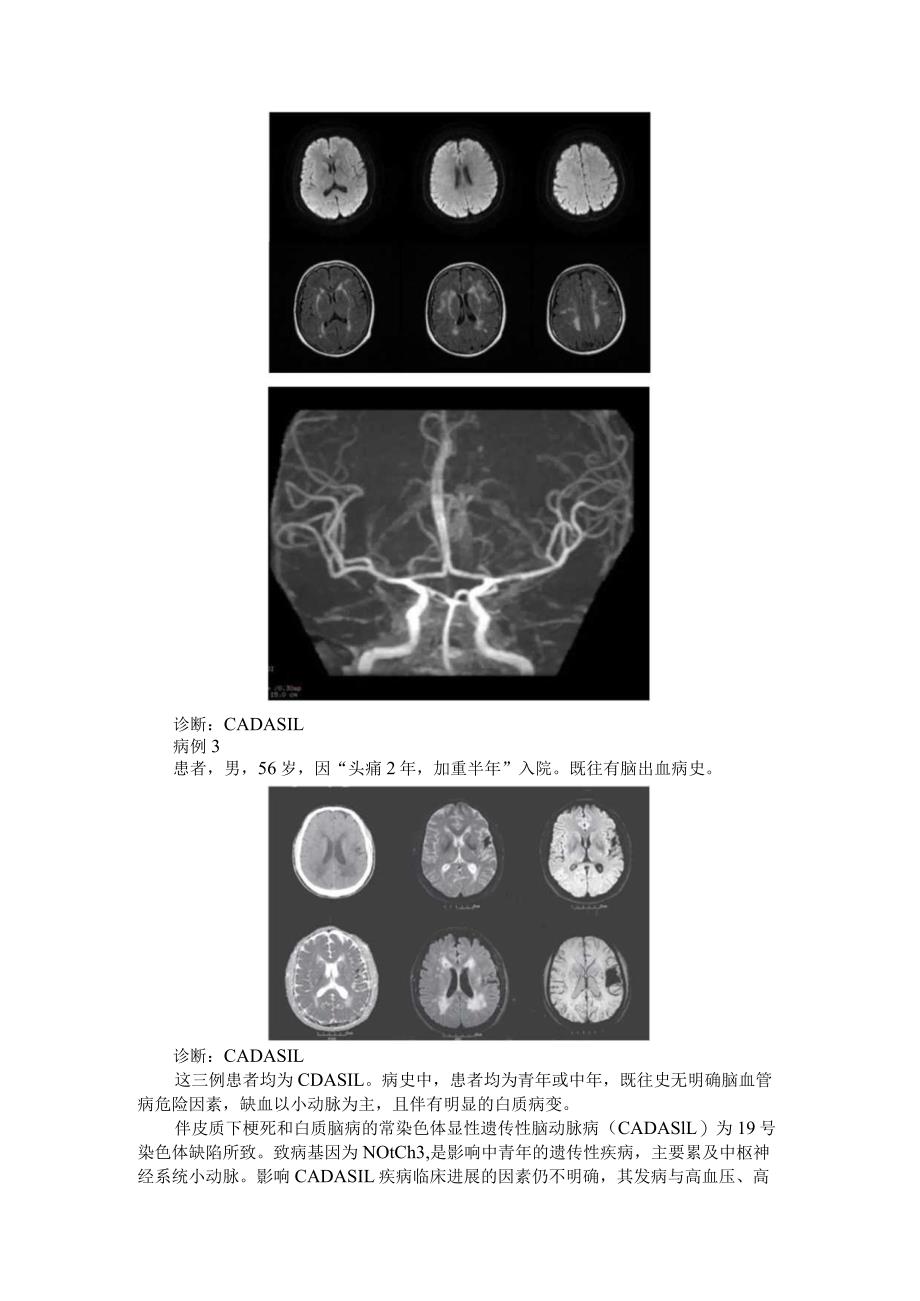 CADASIL 硬脊膜动静脉瘘 恐龙尾征(读片与病例分析).docx_第2页