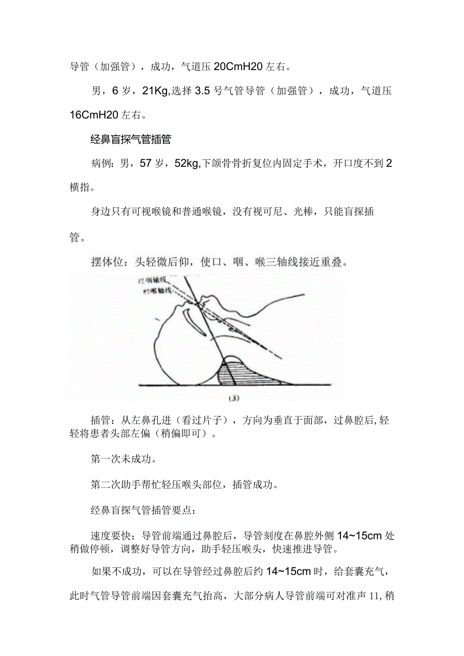 经鼻气管插管临床经验总结.docx_第2页