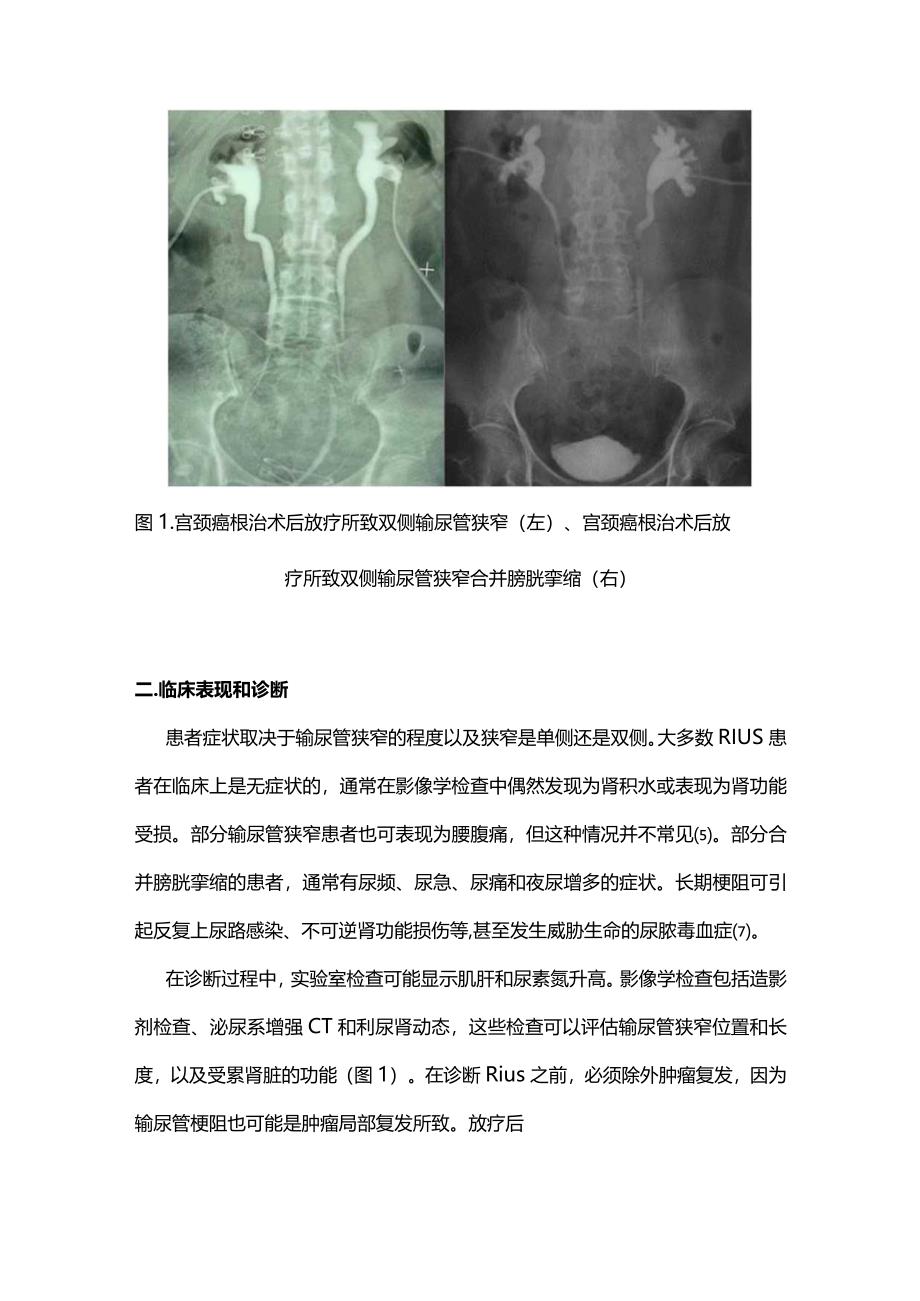 2023放疗所致输尿管狭窄的临床诊疗进展.docx_第2页