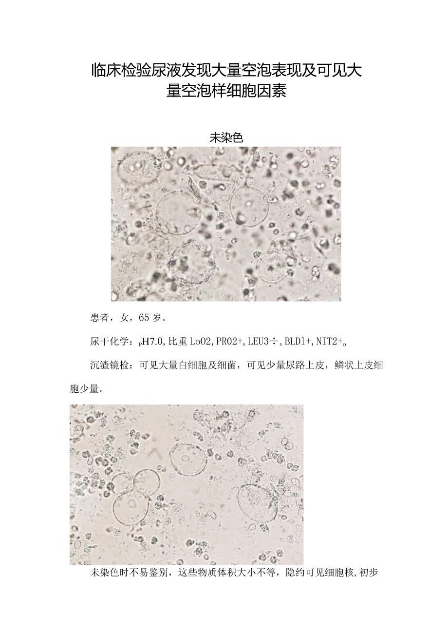 临床检验尿液发现大量空泡表现及可见大量空泡样细胞因素.docx_第1页