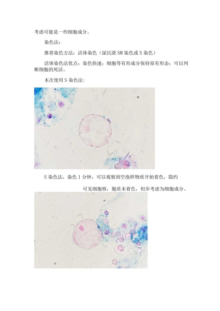 临床检验尿液发现大量空泡表现及可见大量空泡样细胞因素.docx_第2页