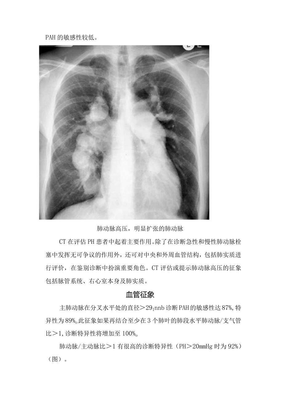 临床肺动脉高压病理、临床表现及心脏征象、血管征象、肺实质征象等征象要点.docx_第3页