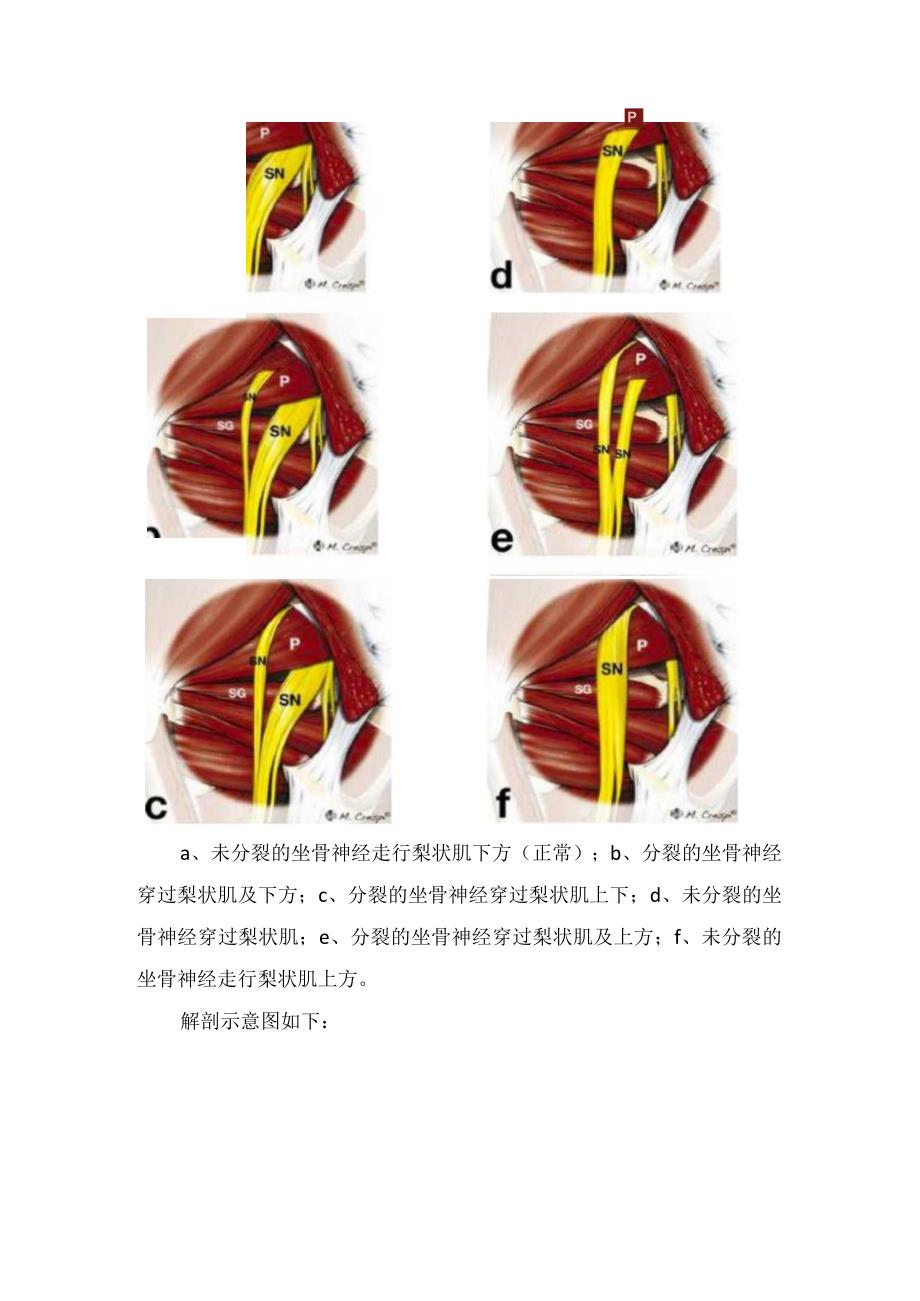 临床坐骨神经位置、梨状肌综合征解剖、变异分型、临床表现、诊断、特殊查体及治疗措施.docx_第3页