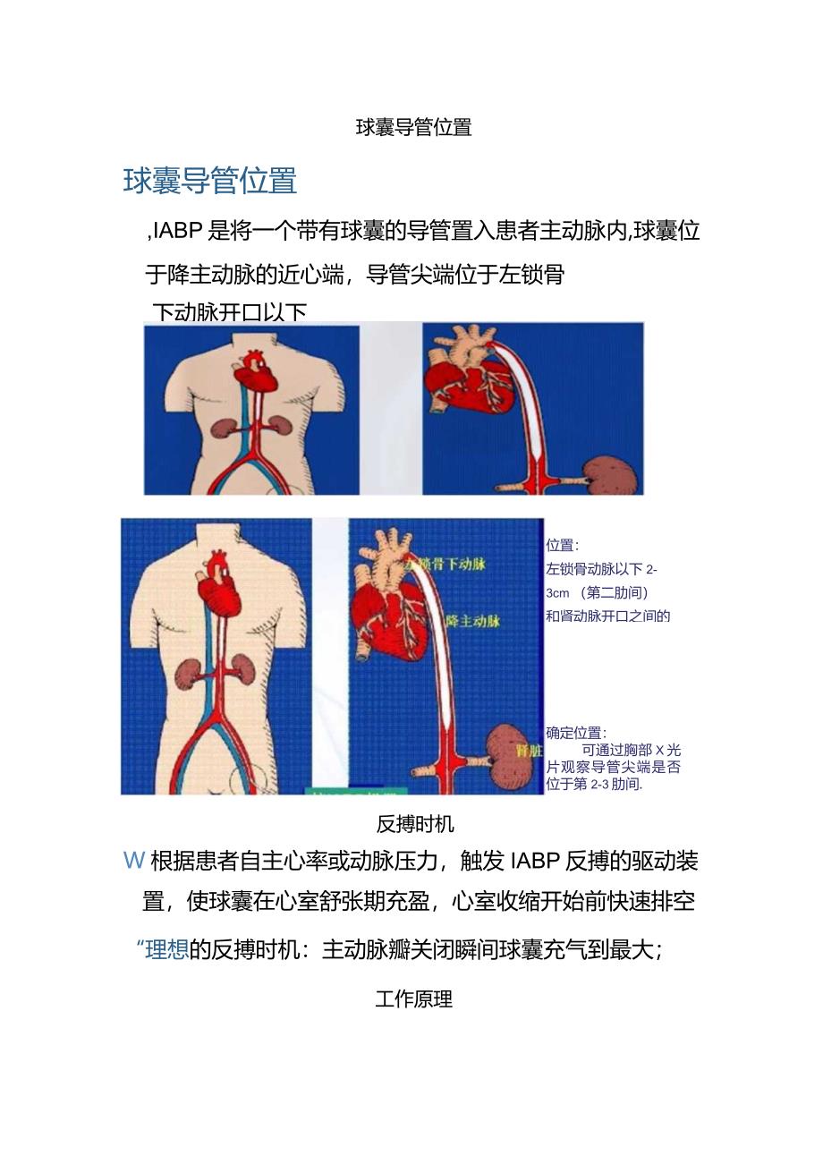 临床主动脉球囊反搏术工作原理、导管选择、适应症、禁忌症、并发症及注意事项.docx_第2页