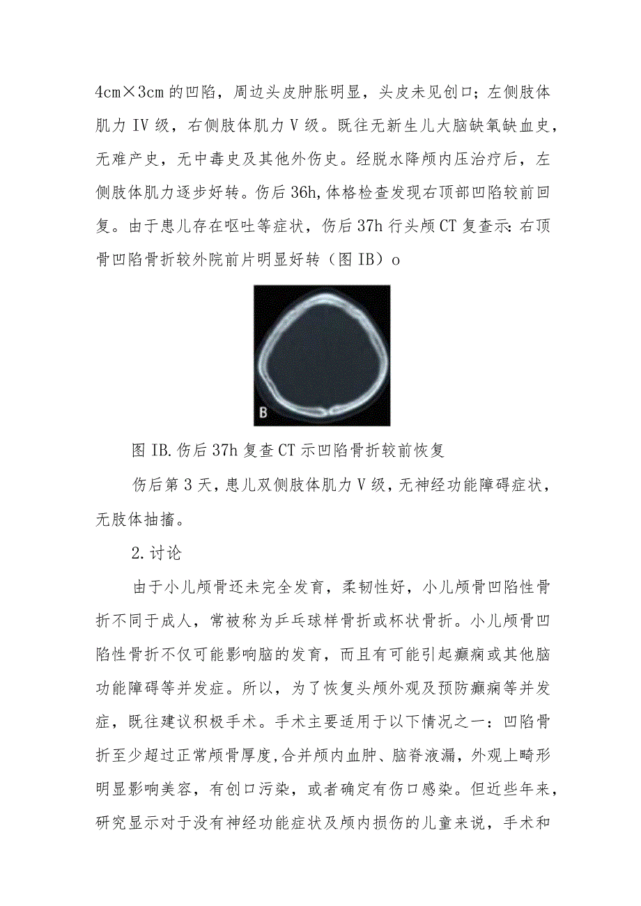 神经外科小儿颅骨凹陷性骨折自发复位病例分析专题报告.docx_第2页