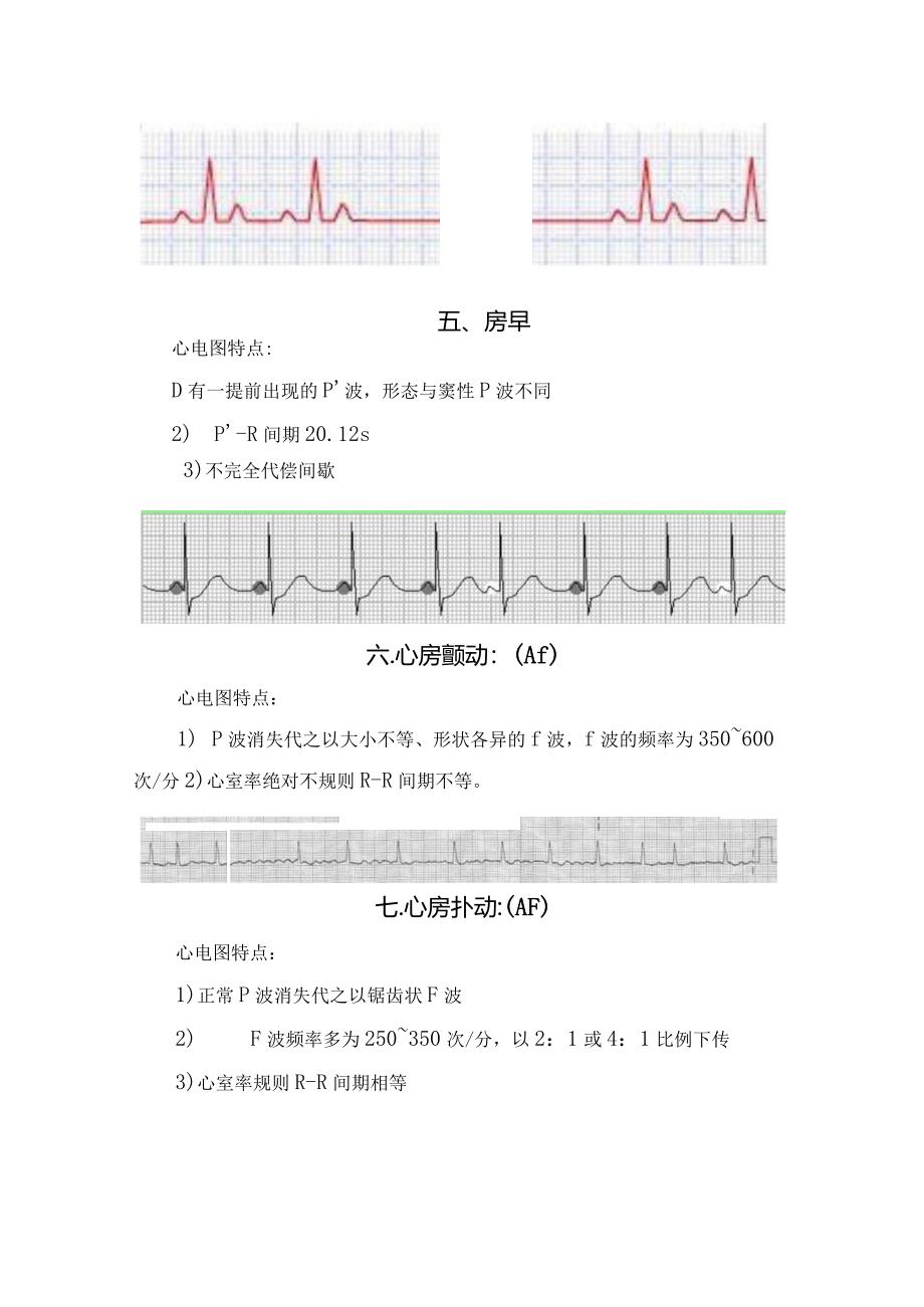 正常窦性心律、窦性停搏、窦性心动过缓等常用20种异常心电图及特点.docx_第3页