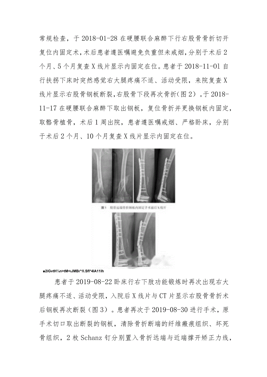 骨外科股骨远端骨折内固定术后顽固性骨折不愈合病例分析专题报告.docx_第2页