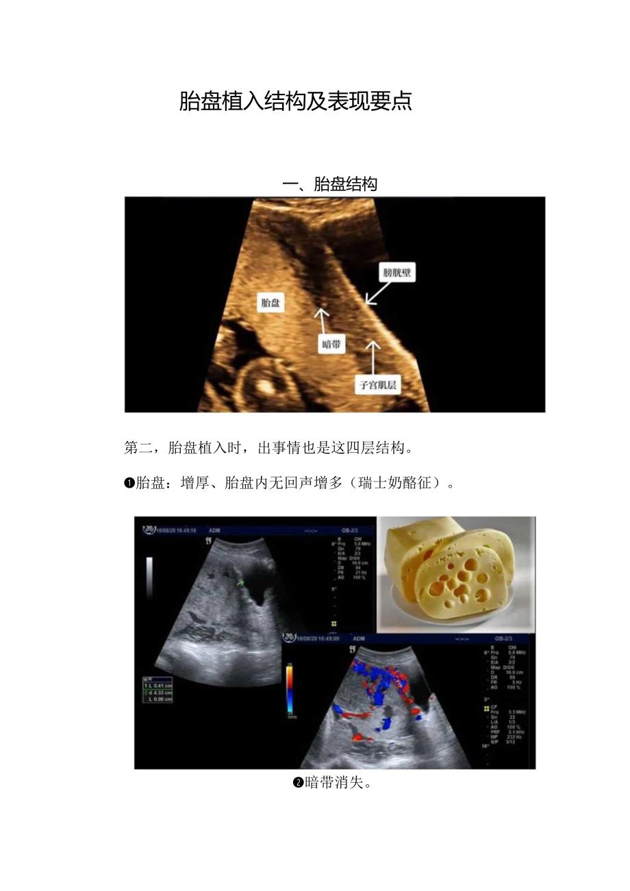 胎盘植入结构及表现要点.docx_第1页