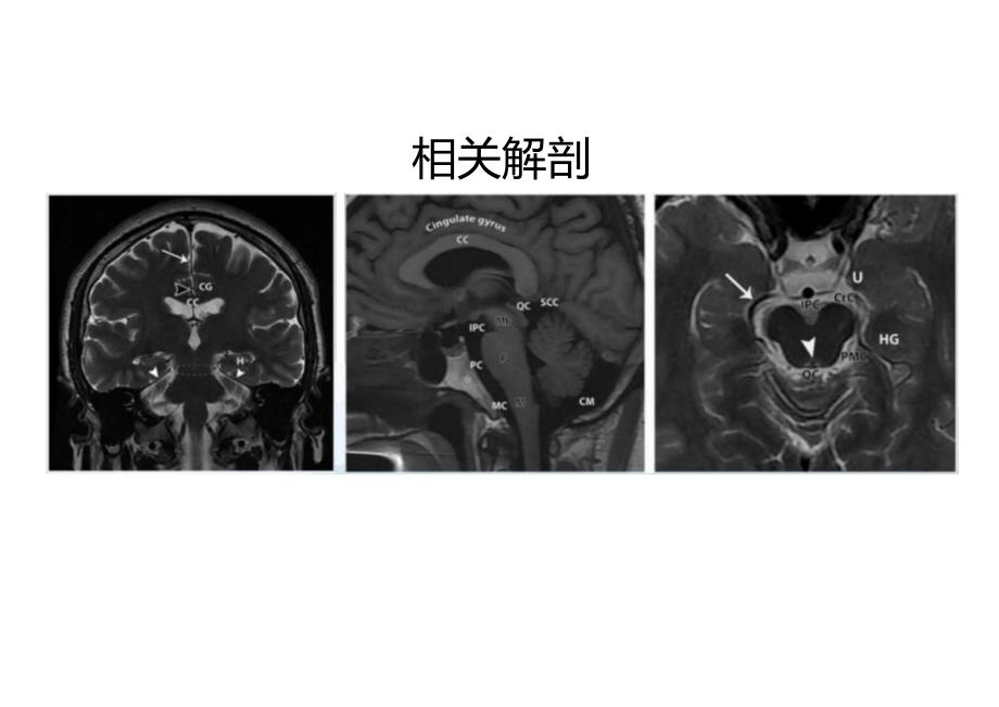 脑疝的影像诊断.docx_第3页