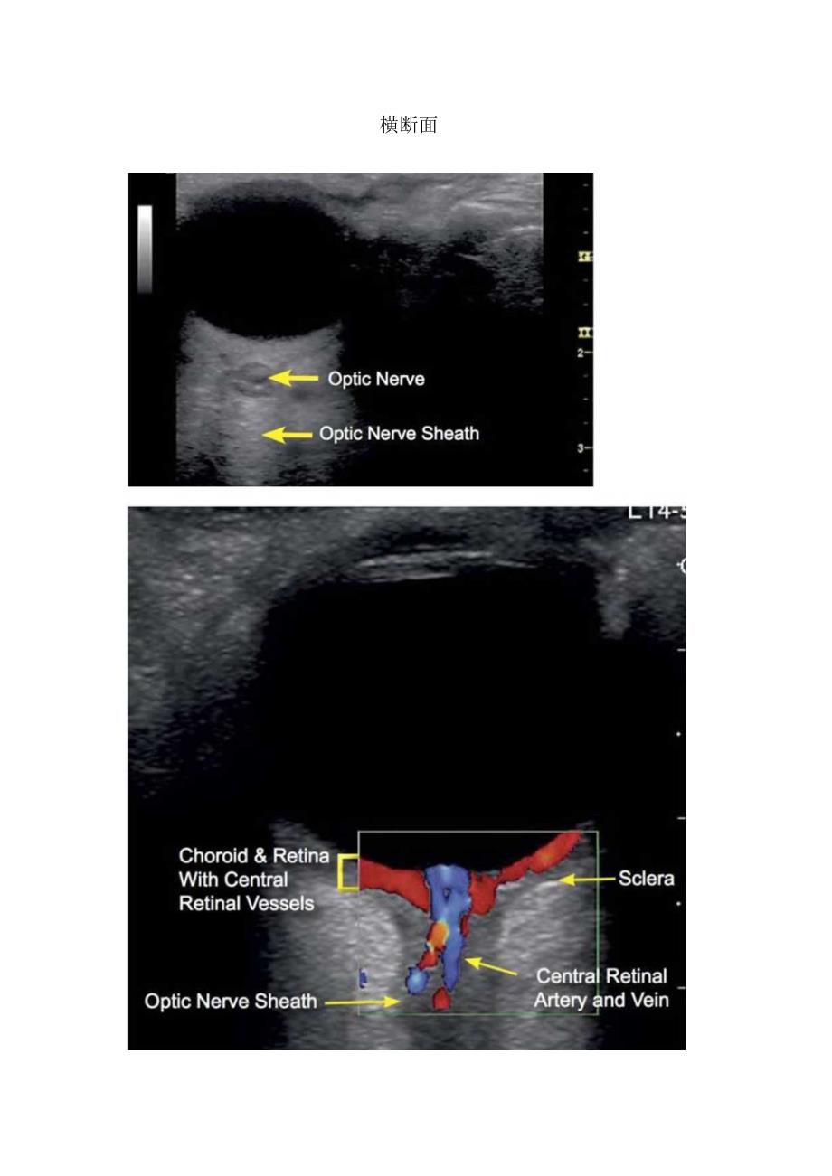 矢状切面、眼底检查等眼部超声检查结构辨认.docx_第2页