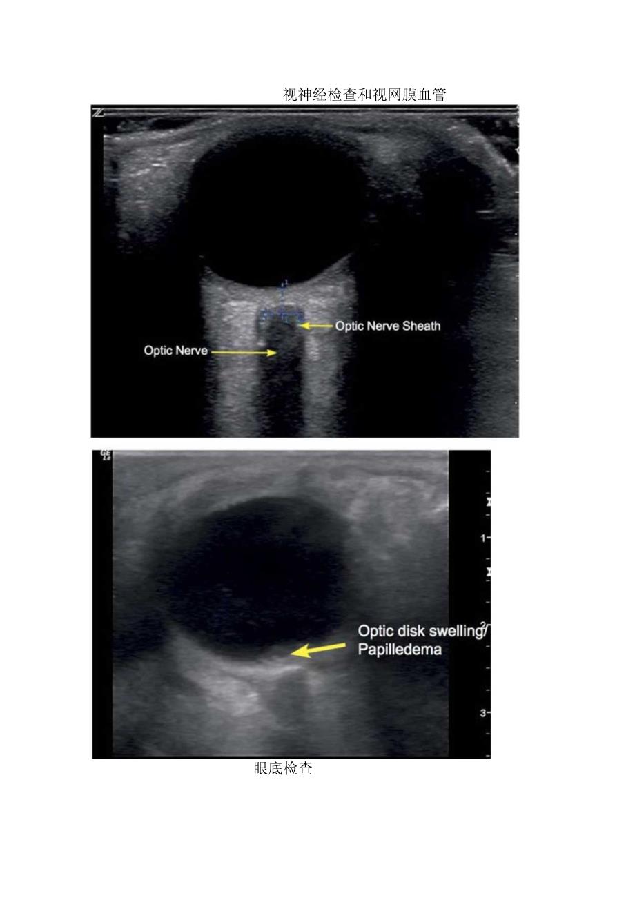 矢状切面、眼底检查等眼部超声检查结构辨认.docx_第3页