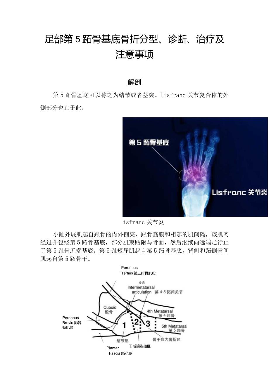 足部第5跖骨基底骨折分型、诊断、治疗及注意事项.docx_第1页