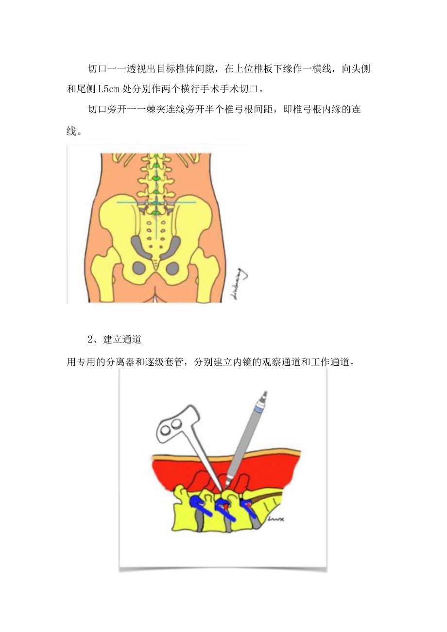 UBE手术入门改良LOVE手术要点.docx_第2页