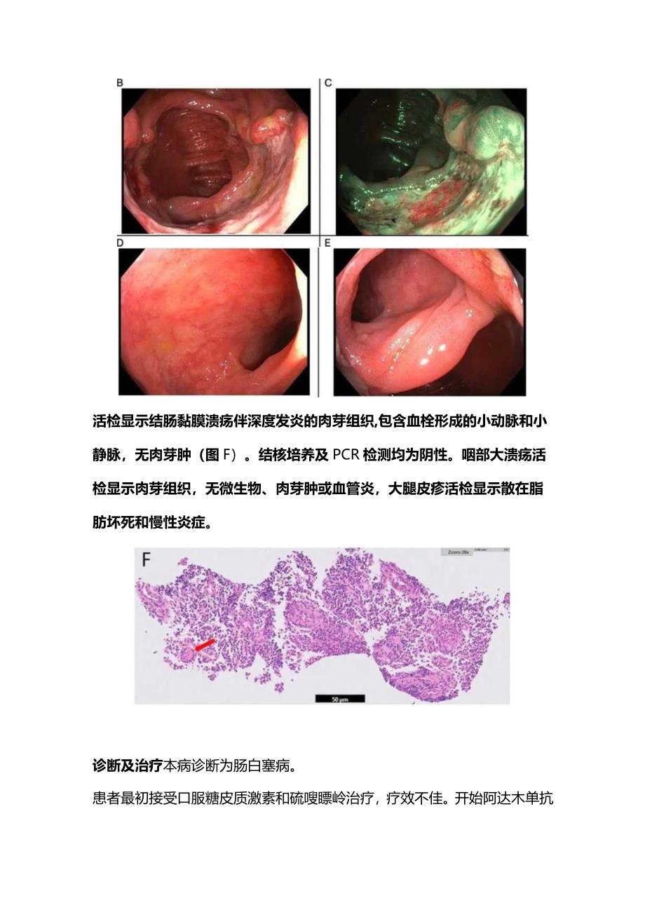 2024肠白塞病的诊治方法.docx_第2页