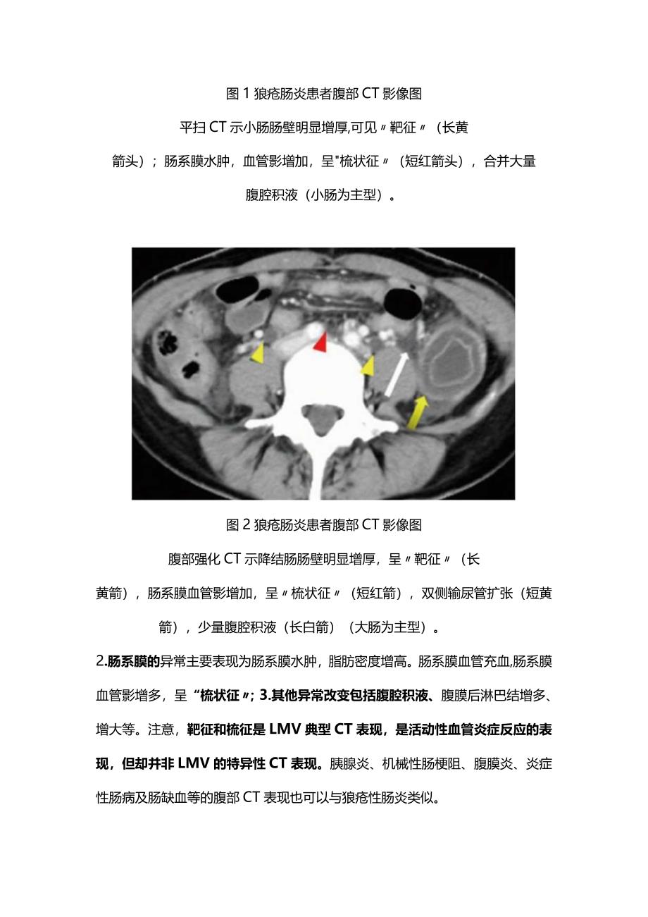 2024狼疮性肠系膜血管炎.docx_第3页