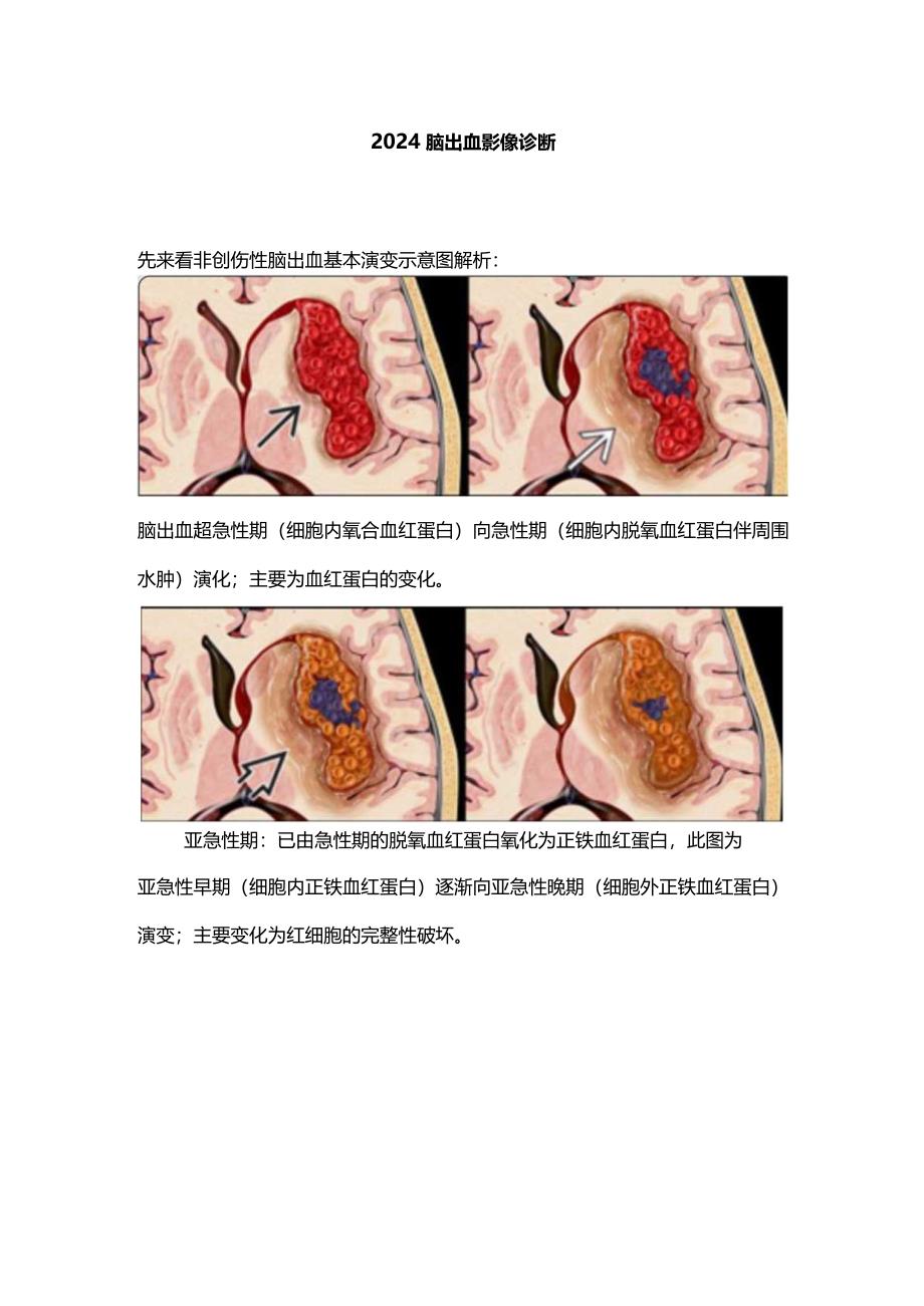 2024脑出血影像诊断.docx_第1页