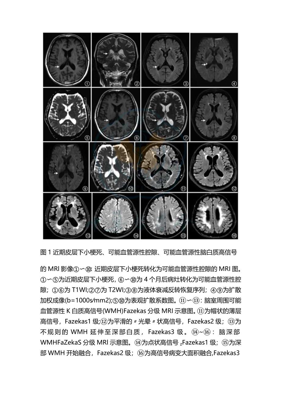 2024脑小血管病的MRI诊断.docx_第3页