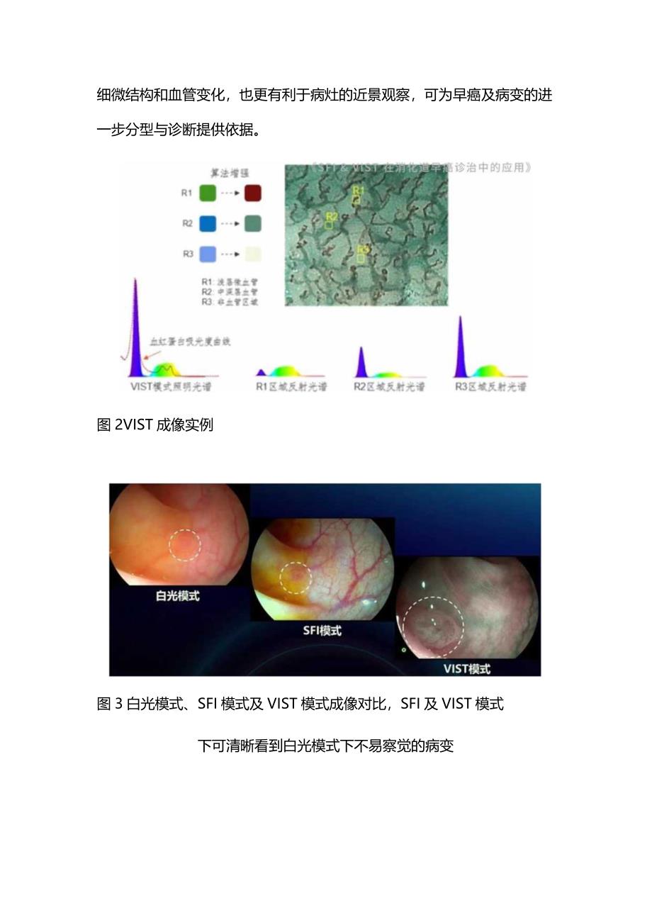 国产自研特殊光技术在消化道早癌诊疗的应用进展2024.docx_第2页