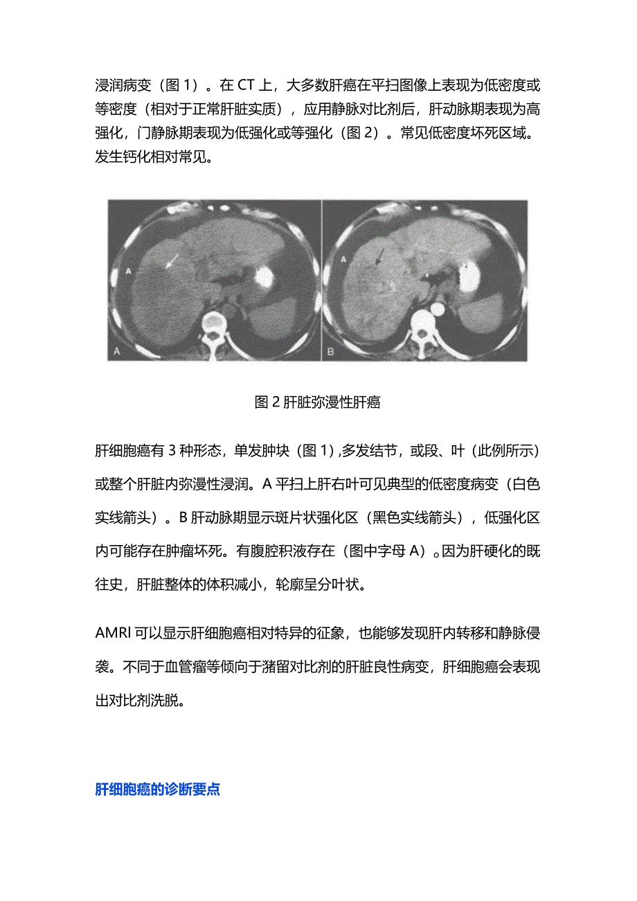 2024肝癌的影像学表现及诊断.docx_第2页