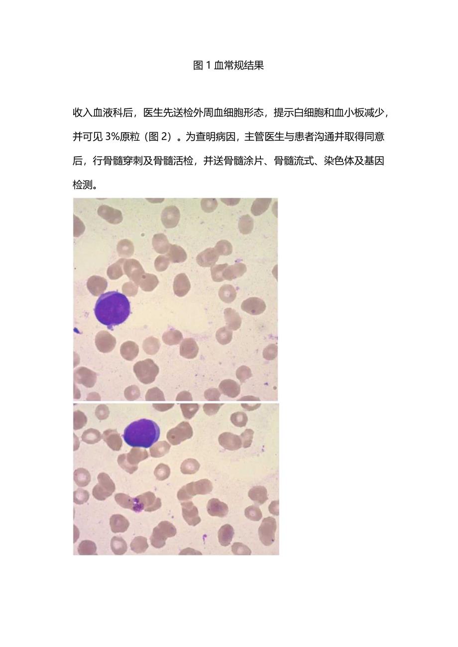 最新：MDS伴骨髓纤维化的诊断过程2024.docx_第2页