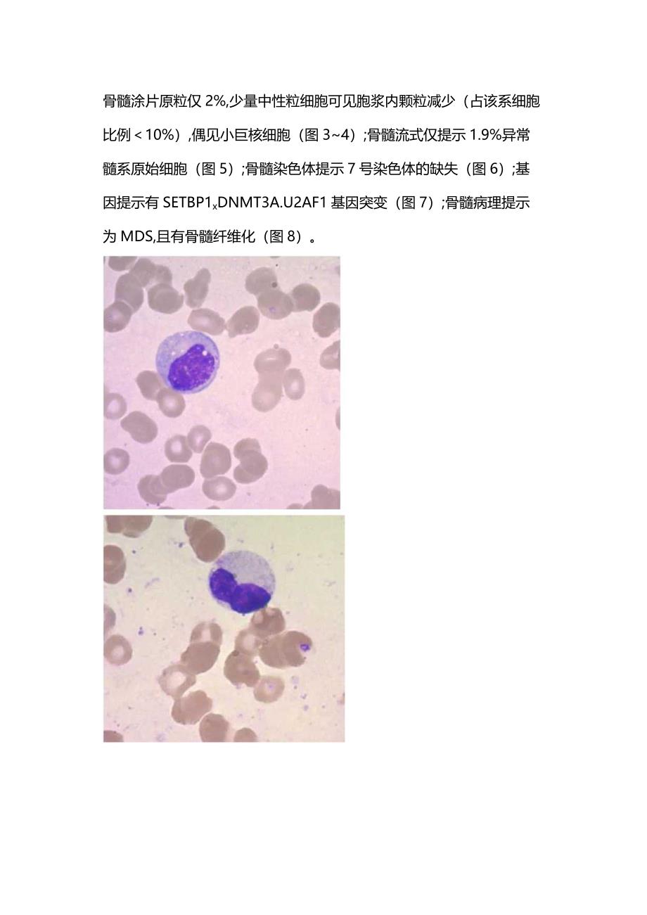 最新：MDS伴骨髓纤维化的诊断过程2024.docx_第3页