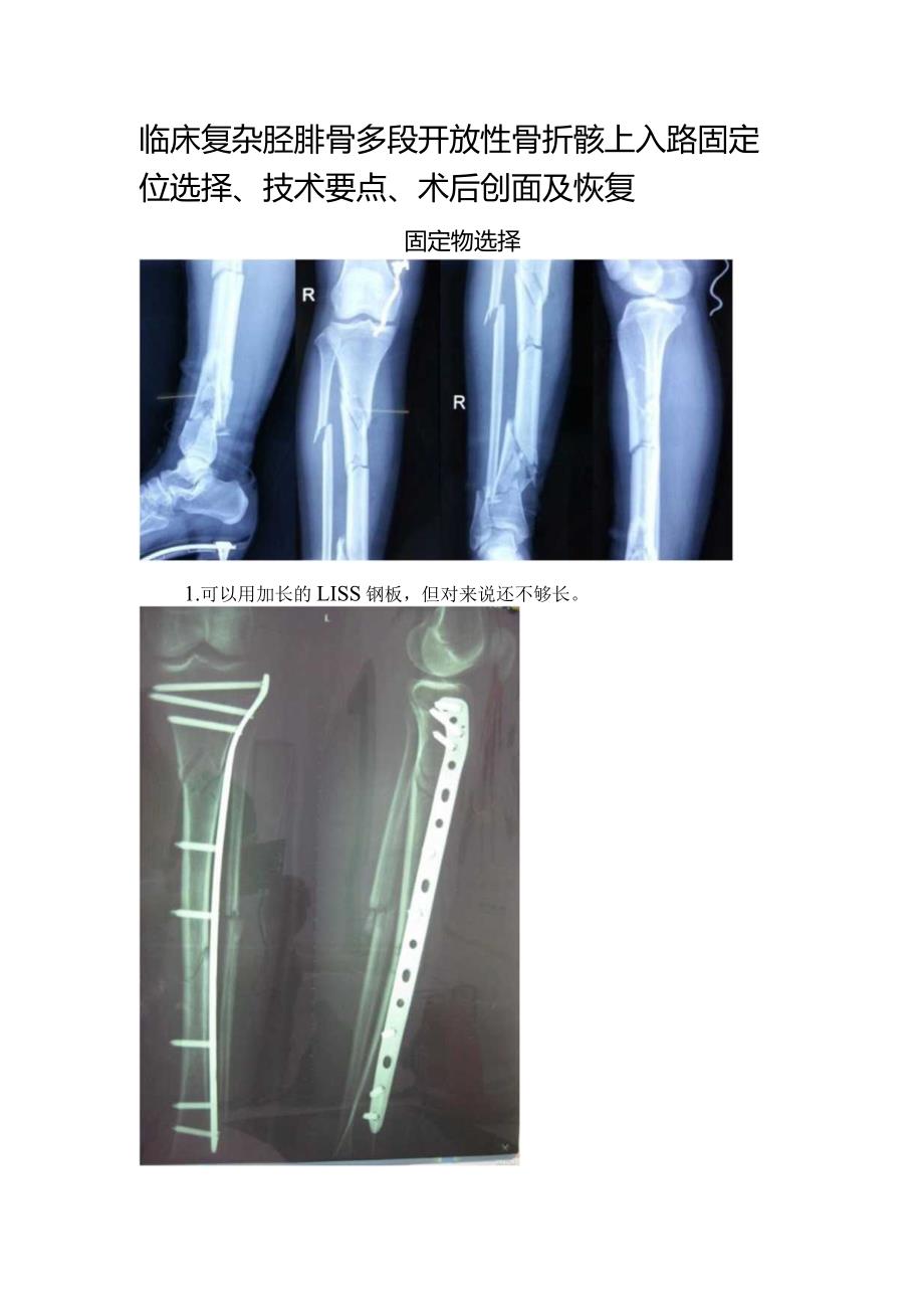 临床复杂胫腓骨多段开放性骨折髌上入路固定位选择、技术要点、术后创面及恢复.docx_第1页