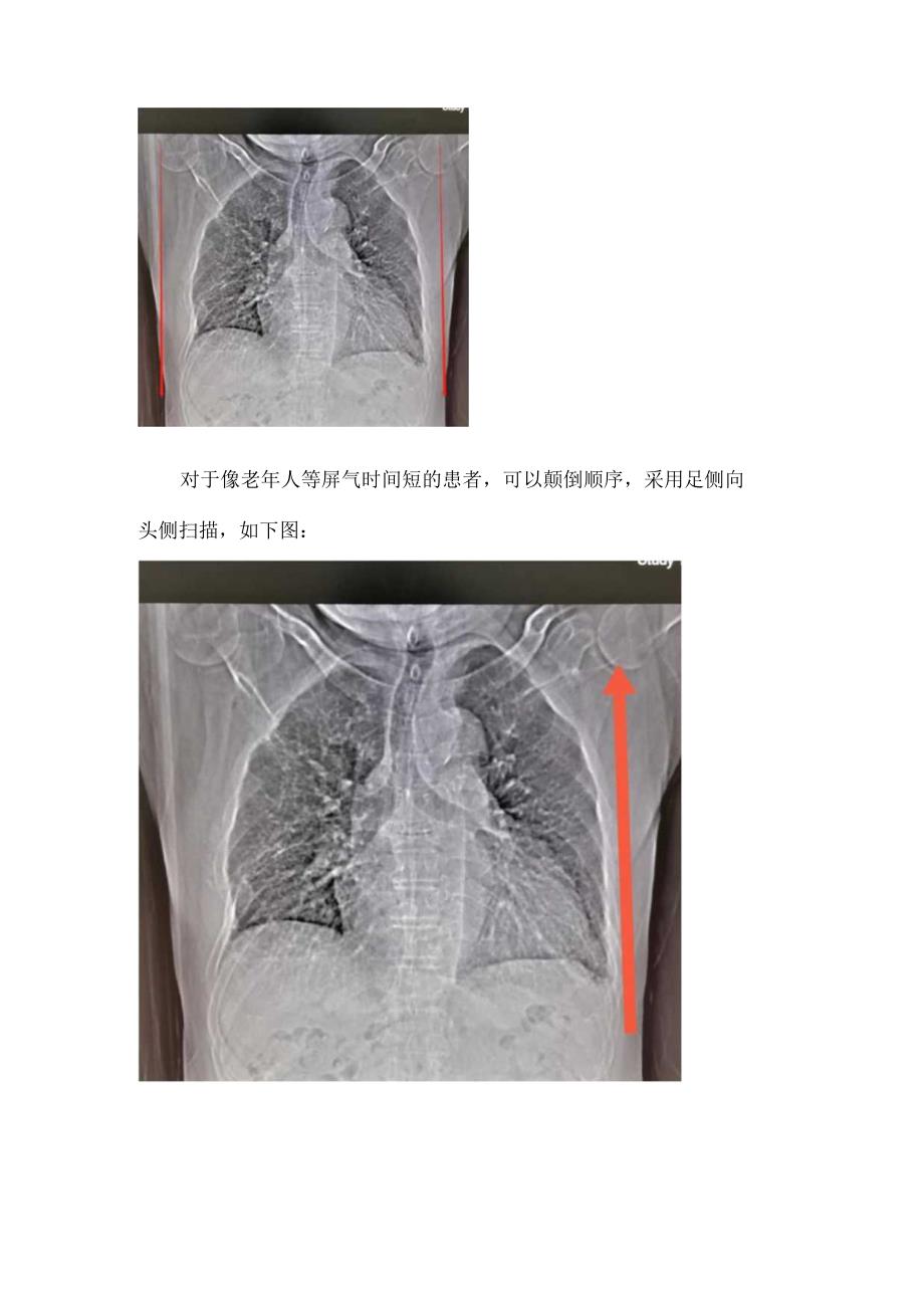 临床胸部CT扫描时屏气不好解决要点.docx_第3页