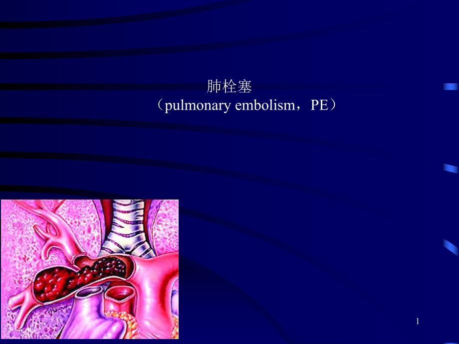 [精彩]肺栓塞讲课.ppt_第1页