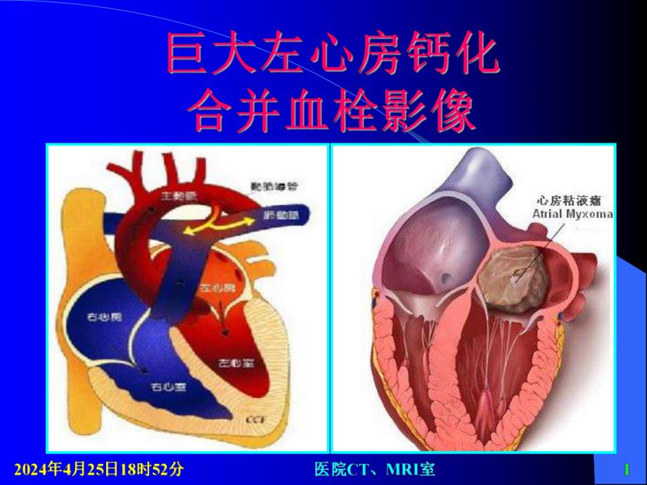 巨大左心房钙化合并血栓影像.ppt_第1页