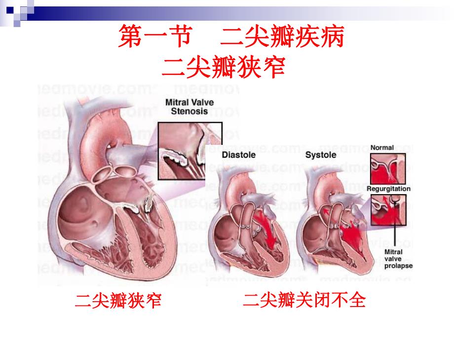 心脏瓣膜病ppt.ppt_第3页