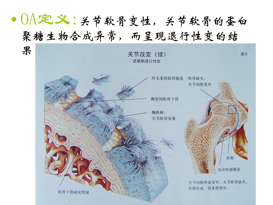 小针刀治疗膝关节骨性关节炎.ppt_第3页