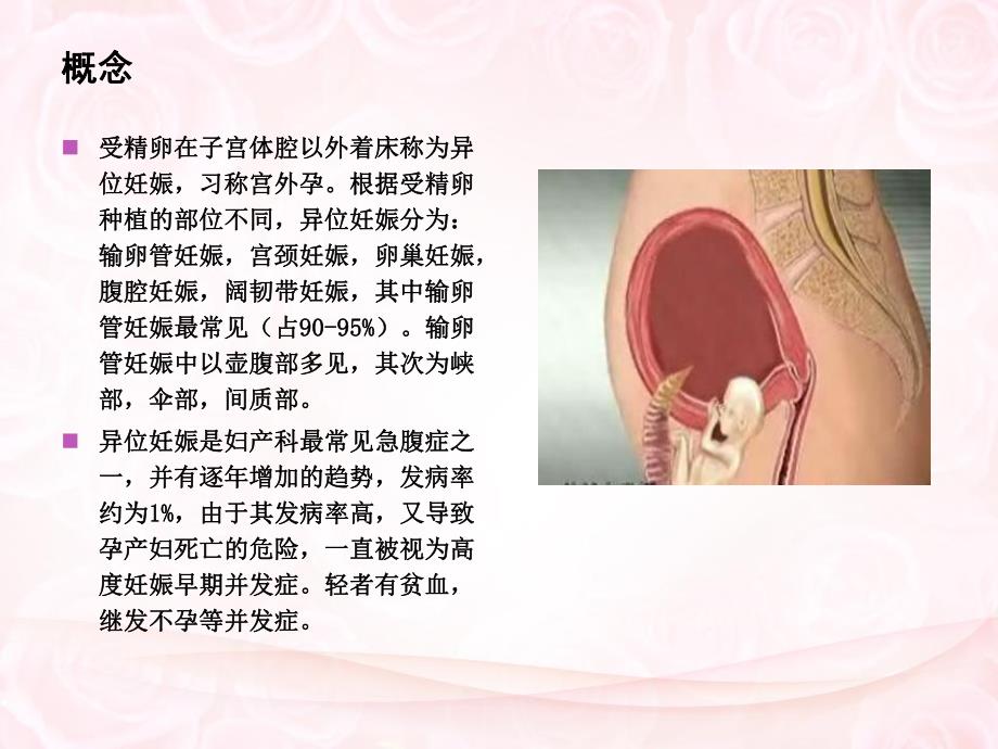 培训资料异位妊娠的中医辩证.ppt_第3页