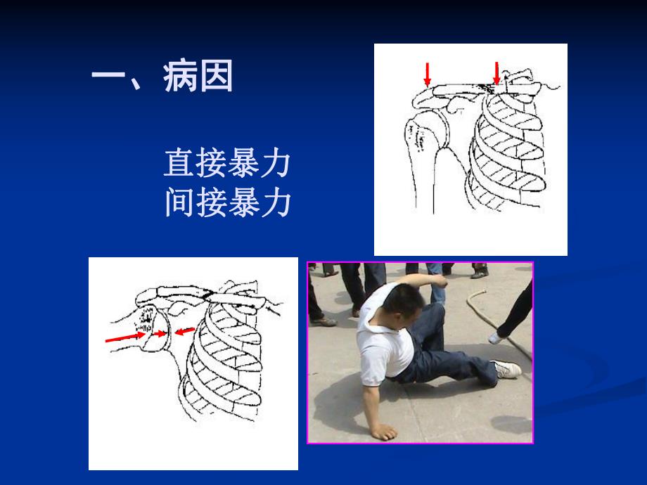 【骨科学课件】11锁骨骨折.ppt_第2页