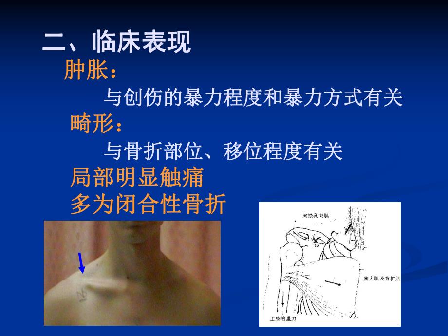 【骨科学课件】11锁骨骨折.ppt_第3页