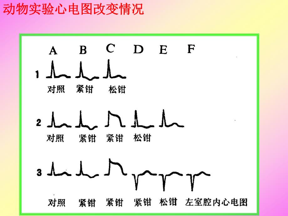 急性心肌梗死心电图演变.ppt_第3页