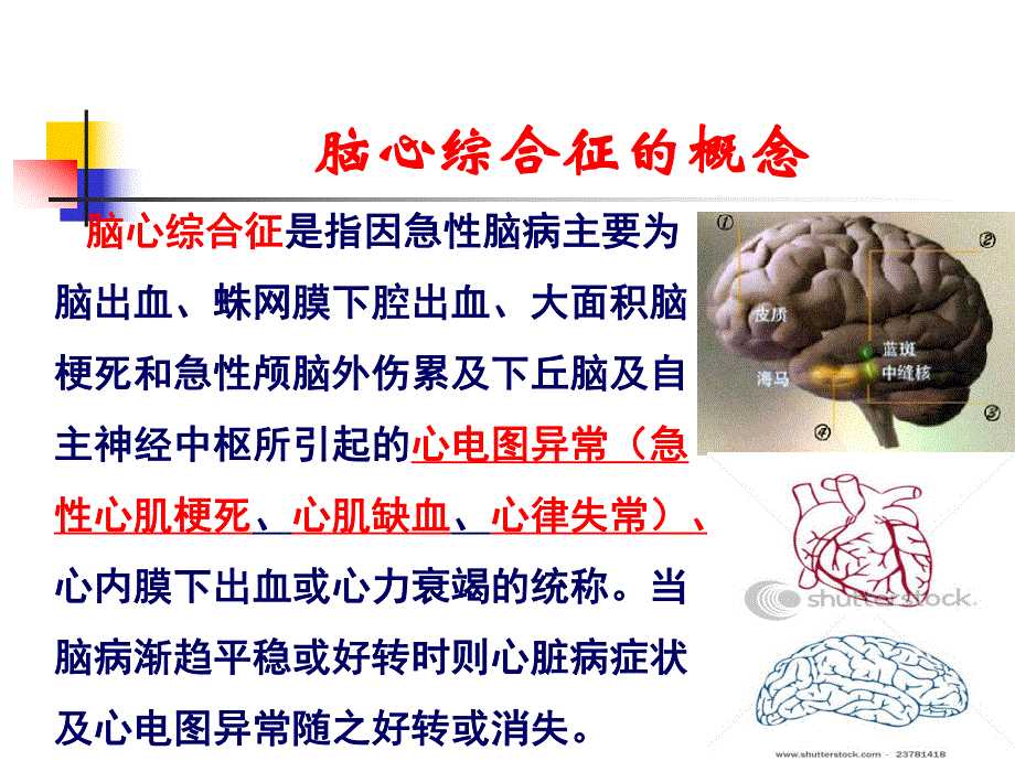 急性脑卒中心电图表现.ppt_第2页