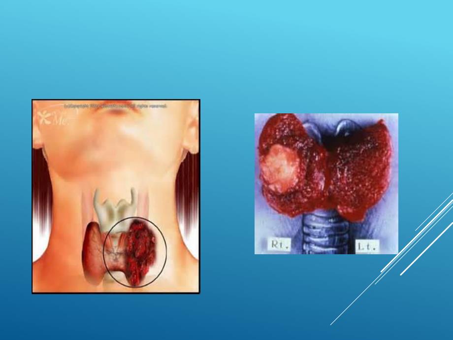 甲状腺tirads分类图文.ppt_第2页